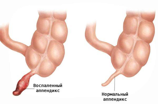 аппендикс
