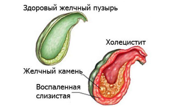 холецистит