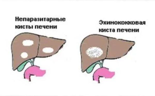 кисты печени