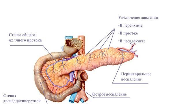 боли при панкреатите