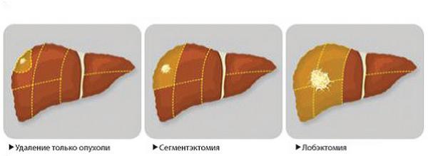 резекция печени