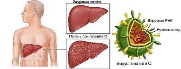 гепатит с