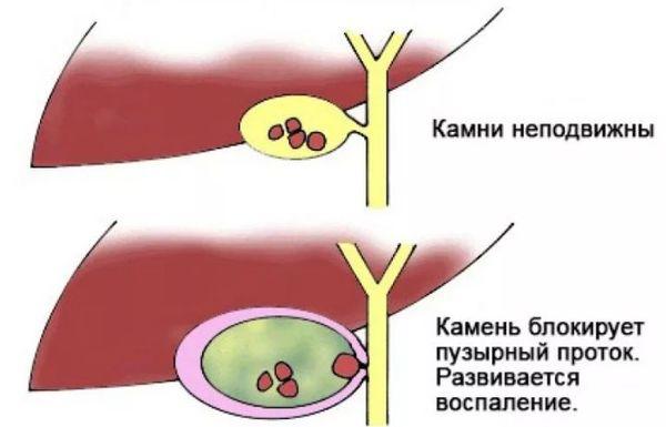 острый холецистит