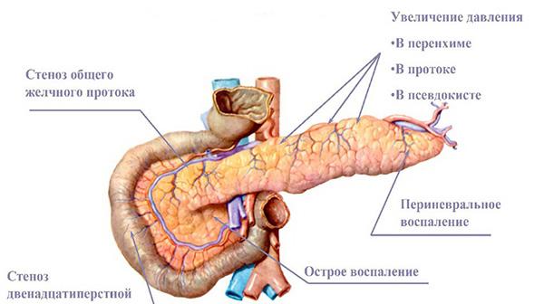 панкреатит