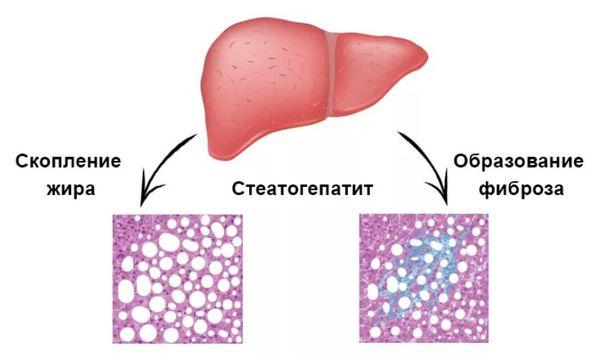 неалкогольный стеатогепатит