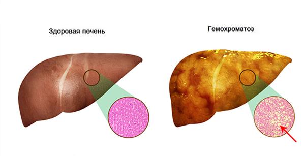 гемохроматоз печени