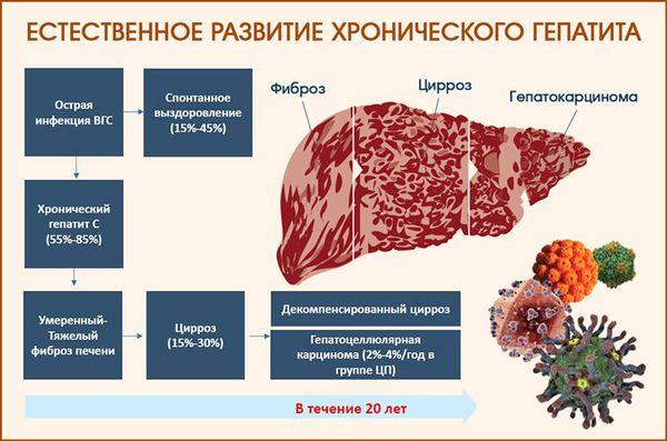 развитие хронического гепатита