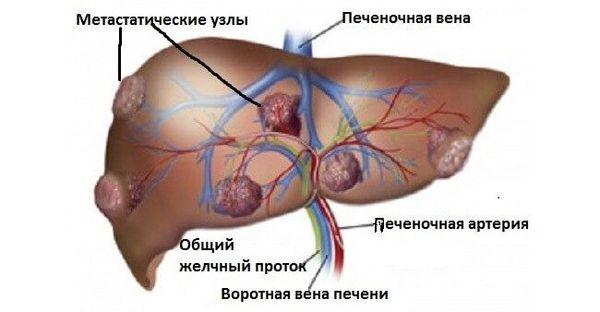 метастазы в печени