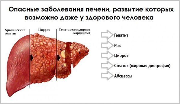 заболевания печени