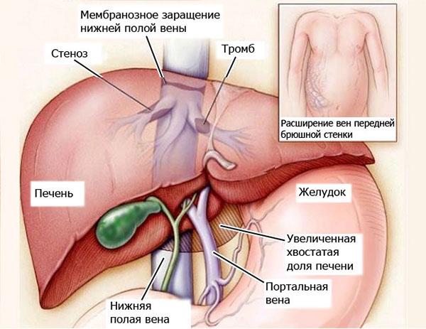 синдром Бадда-Киари