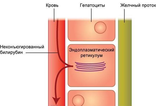 синдром Криглера-Найяра