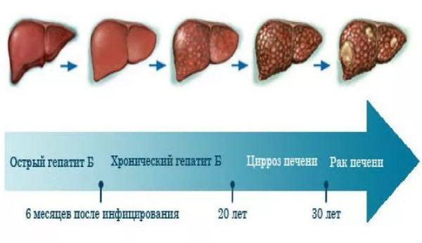 гепатит В