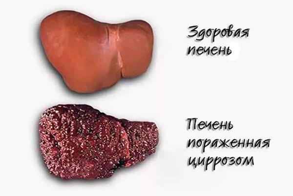 цирроз печени