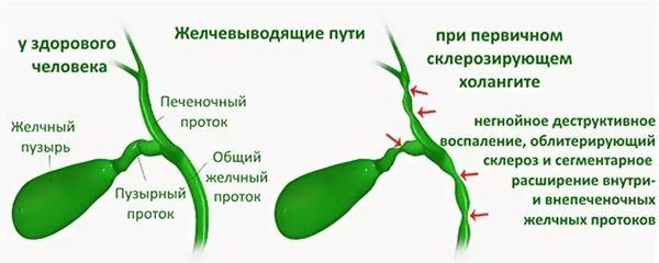 первичный склерозирующий холангит