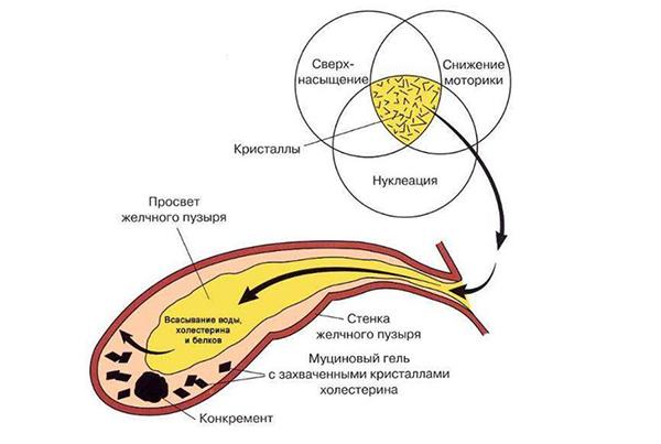рецидивирующий холедохолитиаз