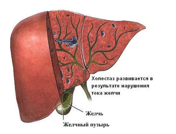 холестаз