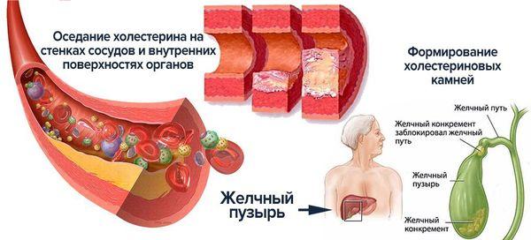 желчный пузырь
