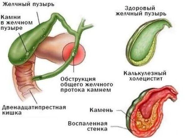 камни в желчном