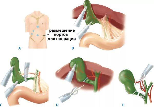 лапароскопическая холецистэктомия