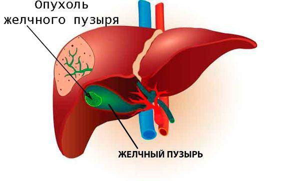 опухоль в желчном пузыре