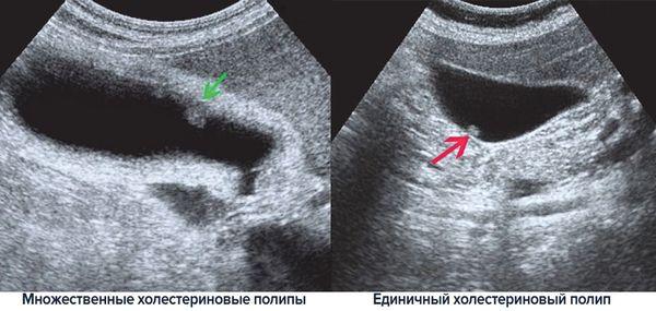 узи желчного пузыря