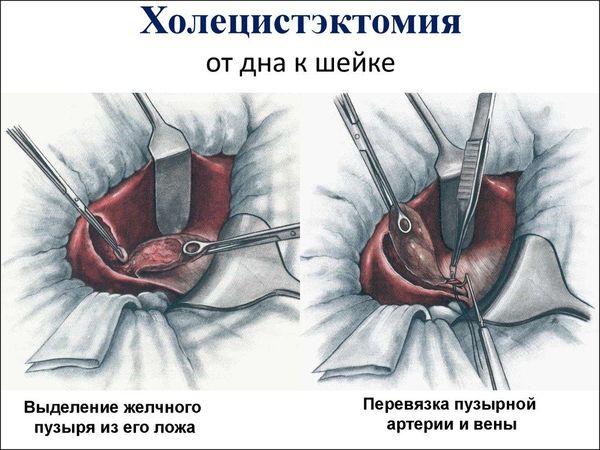 холецистэктомия желчного пузыря