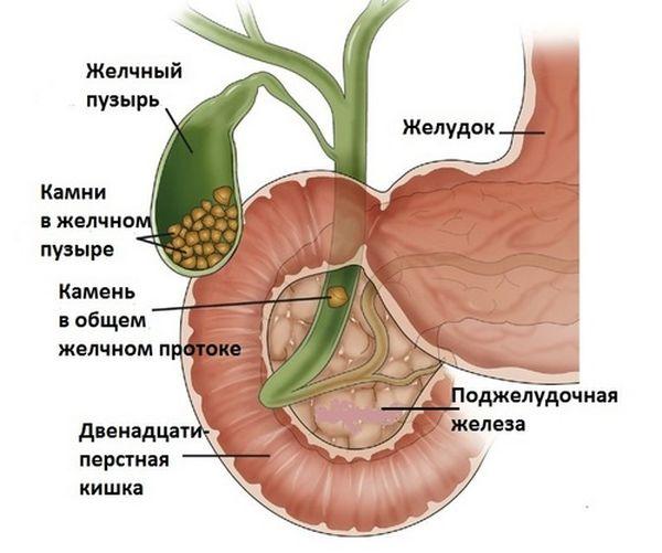камни в желчном