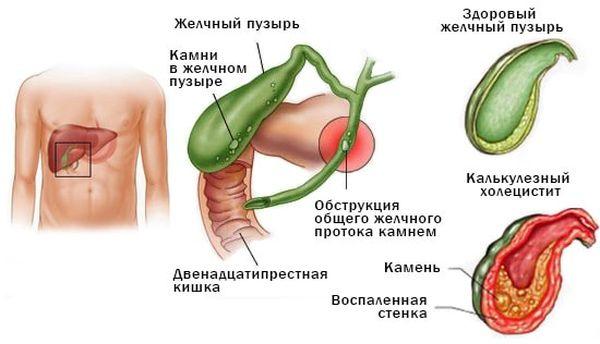 патологии желчного пузыря