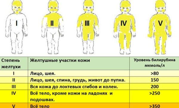 степени желтухи у новорожденных