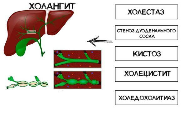 холангит