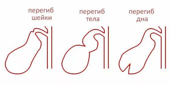 виды перегибов
