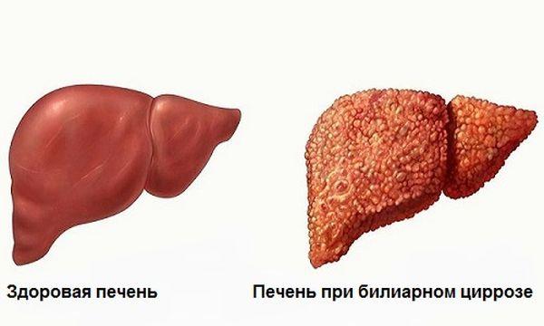 билиарный цирроз