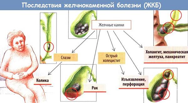последствия ЖКБ