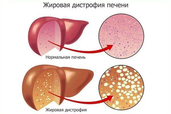 дистрофия печени