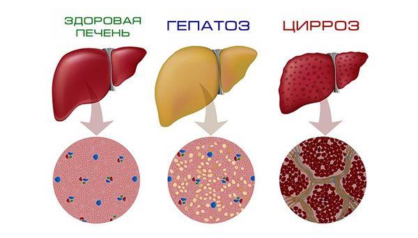 жировая дегенерация печени
