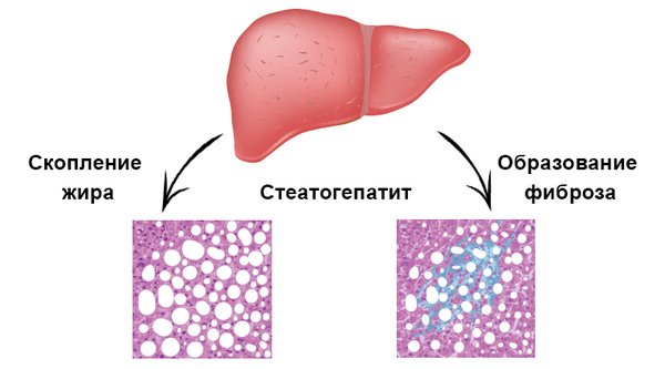 стеатогепатит 