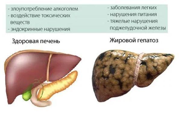жировой гепатоз