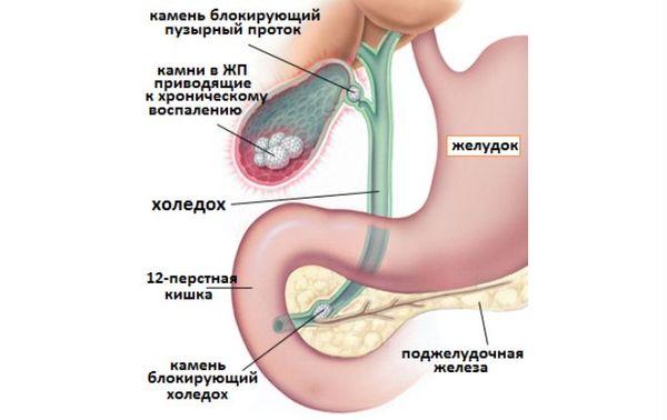 холецистит