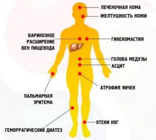 осложнения цирроза печени