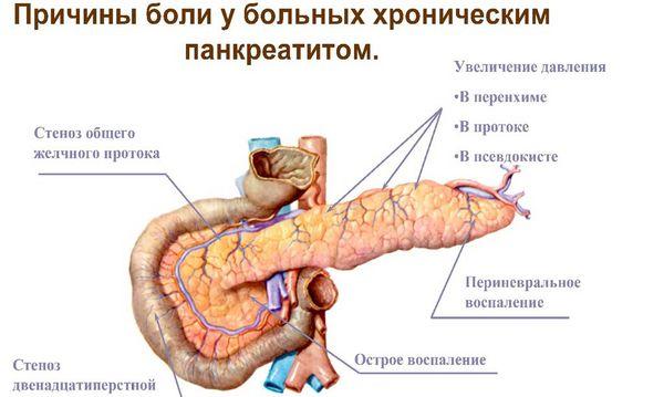 хронический панкреатит