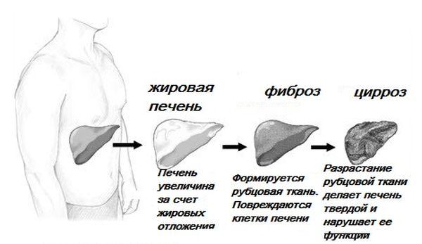 стадии цирроза печени