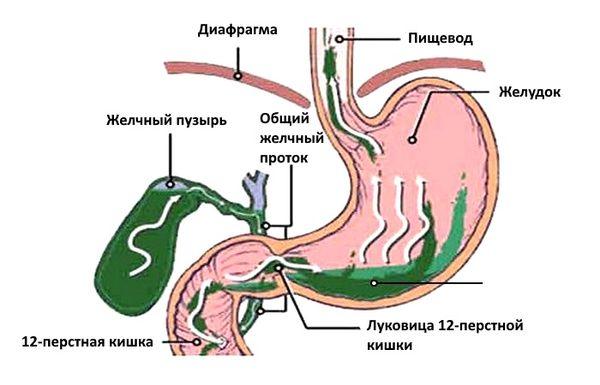 заброс желчи в желудок