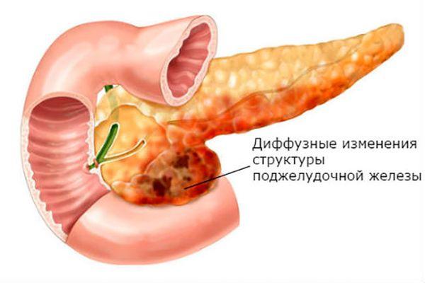 диффузные изменения