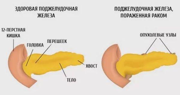 рак поджелудочной
