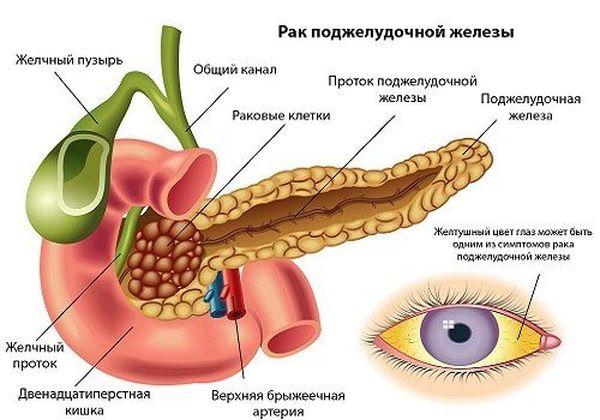 рак поджелудочной железы