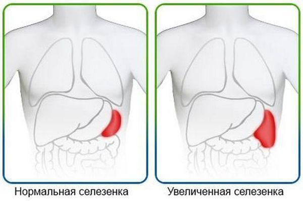 увеличение селезенки