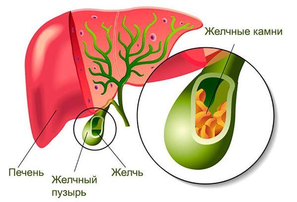 желчнокаменная болезнь
