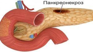 панкреонекроз