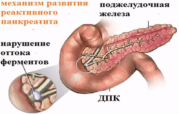 механизм развития панкреатита