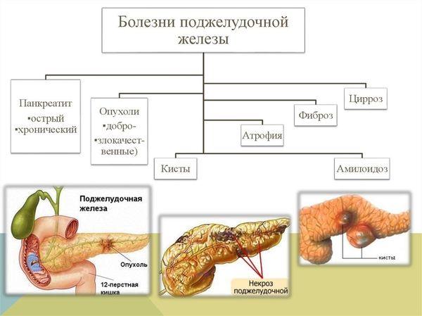 болезни поджелудочной железы